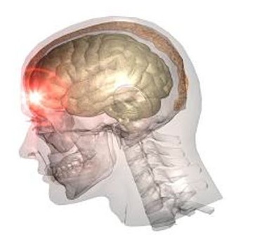 Отек мозга – причины, симптомы, последствия, прогноз для жизни. Отек головного мозга – лечение