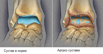 Лечение остеоартроза стопы лечение суставов ног симптомы причины профилактика