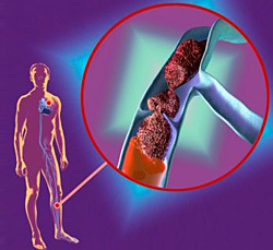 Тромбоз глубоких вен нижних конечностей: симптомы и признаки, методы лечения