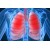 Пневмония - причины, симптомы, современная диагностика и лечение болезни