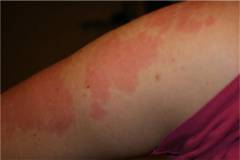 симптомы и лечение аллергии