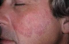 лечение шелушения кожи лица