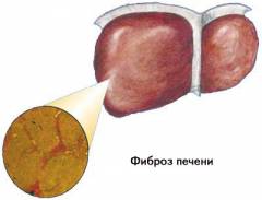 очаговый фиброз печени