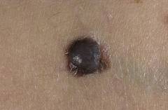 Как выглядит рак кожи
