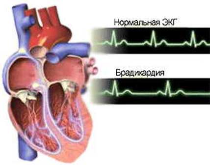 Что такое брадикардия сердца - лечение народными средствами и препаратами, чем опасно заболевание