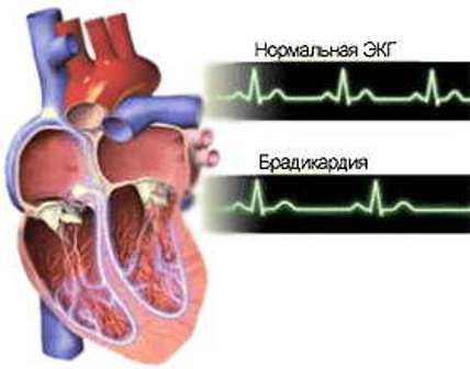 Что значит брадикардия у взрослых