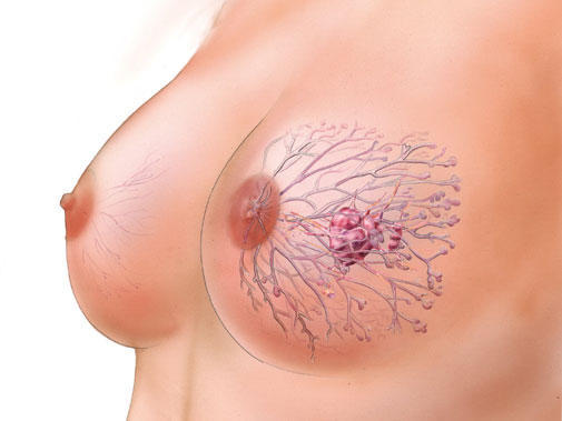 Рак грудины у женщин, фото, признаки и симптомы