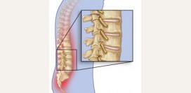 Болезнь Бехтерева - причины, симптомы диагностика и лечение