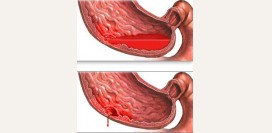 Желудочное кровотечение. Причины, симптомы, диагностика и лечение патологии