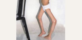 Полиомиелит. Причины, симптомы и признаки, диагностика и лечение болезни