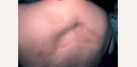 Склеродермия. Причины, симптомы и признаки, диагностика и лечение болезни