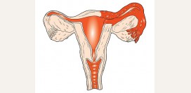 Сальпингит (воспаление маточных труб). Причины, симптомы и признаки, диагностика и лечение болезни