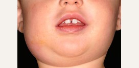 Эпидемический паротит. Причины, симптомы и признаки, диагностика и лечение болезни