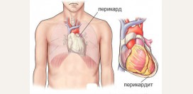 Перикардит. Причины, симптомы, признаки, диагностика и лечение патологии