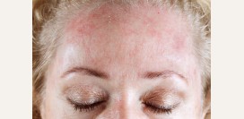 Аллергия на холод. Причины, симптомы, признаки, диагностика и лечение патологии