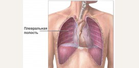 Плеврит. Причины, симптомы, признаки, диагностика и лечение патологии