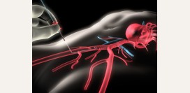Коронарография. Что такое коронарография, показания, какие болезни выявляет