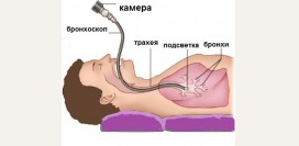 Бронхоскопия. Что такое бронхоскопия, показания, противопоказания, виды исследования