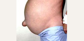 Пупочная грыжа у взрослых. Причины, симптомы, диагностика и лечение