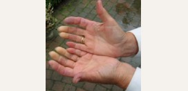 Синдром Рейно. Причины, симптомы и признаки, диагностика и лечение болезни