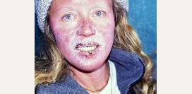 Обморожение (отморожение). Причины, первая помощь, степени и возможные последствия