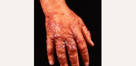 Ожог. Виды, первая помощь, степени и возможные последствия