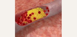 Диабетическая ангиопатия. Ангиопатия сосудов нижних конечностей, симптомы, диагностика, лечение и профилактика