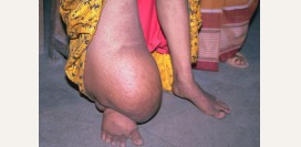 Cлоновость. Причины, симптомы и признаки, диагностика и лечение патологии