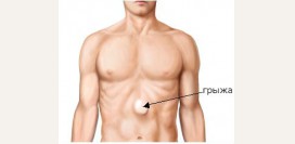 Грыжа белой линии. Причины, симптомы, диагностика и лечение
