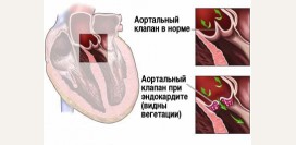 Эндокардит. Причины, симптомы, признаки, диагностика и лечение патологии
