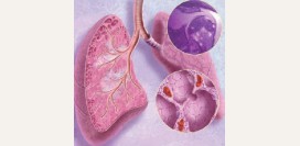 Саркоидоз. Причины, симптомы, признаки, диагностика и лечение патологии