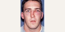 Перелом носа. Причины, симптомы, виды, первая медицинская помощь и реабилитация