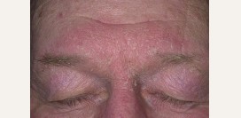 Себорейный дерматит. Причины, симптомы, признаки, диагностика и лечение патологии