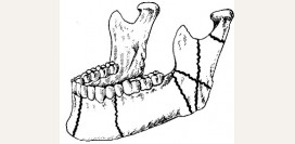 Перелом челюсти. Причины, симптомы, виды, первая медицинская помощь и реабилитация
