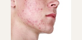 Демодекоз. Причины, симптомы, признаки, диагностика и лечение патологии