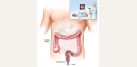 Колоноскопия. Что такое колоноскопия, показания, какие болезни выявляет