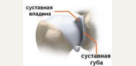 Вывих плечевого сустава (плеча). Причины, симптомы, виды, первая медицинская помощь и реабилитация
