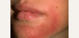 Атопический дерматит у взрослых. Причины, симптомы, признаки, диагностика и лечение патологии