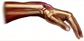 Перелом лучевой кости. Причины, симптомы, виды, первая медицинская помощь и реабилитация