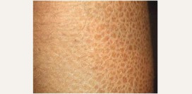 Ихтиоз. Причины, симптомы, признаки, диагностика и лечение патологии