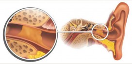 Серная пробка. Причины, симптомы и признаки, удаление
