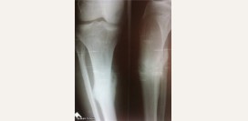 Саркома. Причины, симптомы, признаки, диагностика и лечение патологии