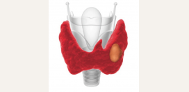 Узлы щитовидной железы. Причины, симптомы, признаки, диагностика и лечение патологии