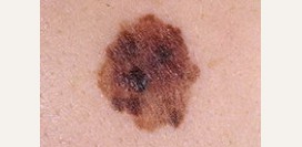 Меланома. Причины, симптомы, признаки, диагностика и лечение болезни