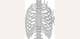 Переломы ребер. Причины, симптомы, первая медицинская помощь и реабилитация