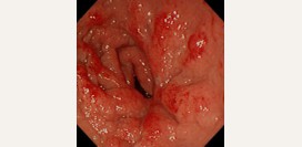 Дуоденит. Причины, симптомы, признаки, диагностика и лечение патологии