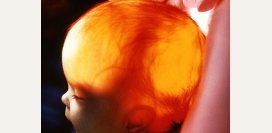 Гидроцефалия. Причины, симптомы, признаки, диагностика и лечение патологии