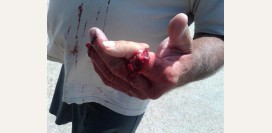 Перелом пальца руки. Причины, симптомы, виды, первая медицинская помощь и реабилитация