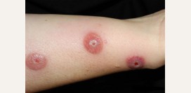 Пиодермия. Причины, симптомы, признаки, диагностика и лечение патологии