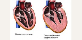 Кардиомиопатия. Причины, симптомы, признаки, диагностика и лечение патологи